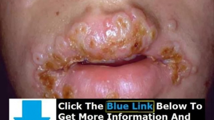 Can You Get Rid Of Herpes Simplex 1 + Get Rid Of Herpes