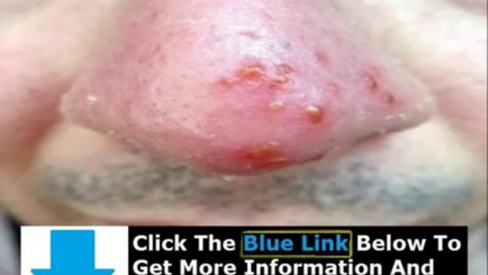 How To Get Rid Of Herpes Bumps + Get Rid Of Herpes Sore