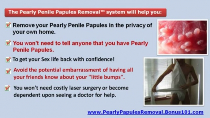 pearly penile papules - pearly penile papules removal at home - sebaceous glands penis