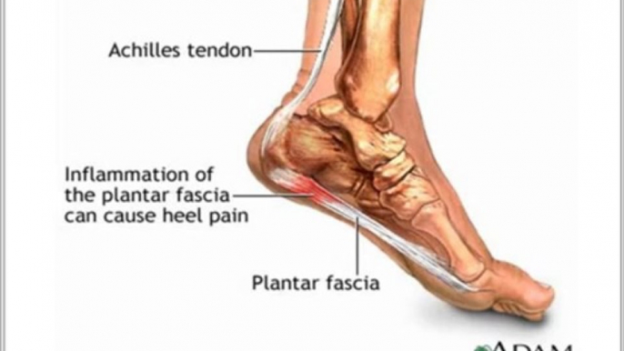 Pain in Heel of Foot | How to Get Rid of Plantar Fasciitis, Achilles Tendonitis Pain in Heel of Foot