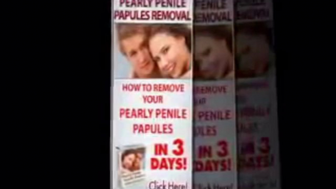 Pearly Penile Papules Removal - Real Pearly Penile Papules Removal