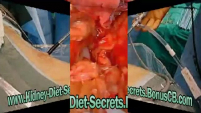 kidney diet secrets - kidney diet plan - kidney diet secrets book - kidney transplant recipes