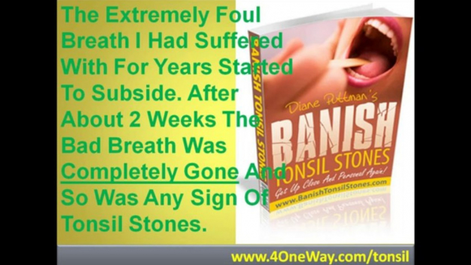 Getting Rid Of Tonsil Stones | Banish Tonsil Stones