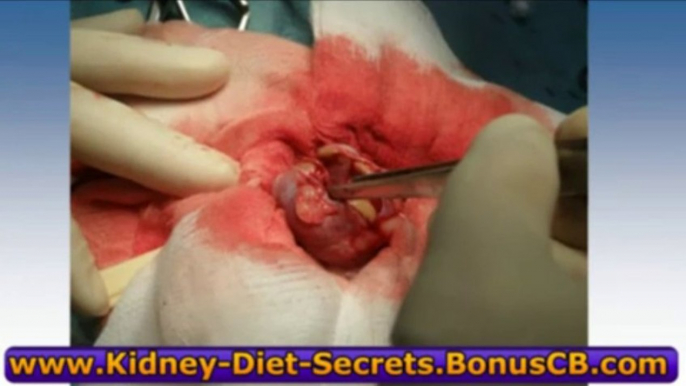 Kidney Disease Diet Renal Failure Diet - Kidney Diet Secrets - Dialysis Renal Cookbook Recipes