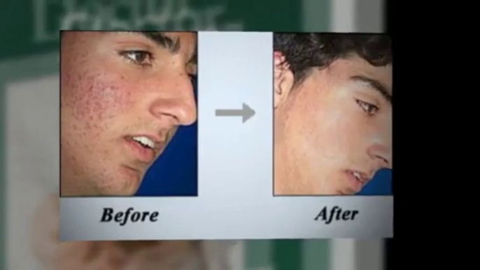 Acne No More