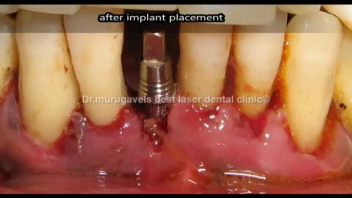 Lower shaking tooth extraction and immediate implant placement