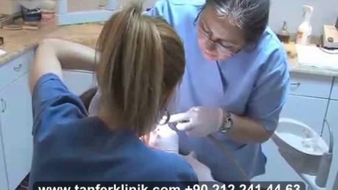 Tanfer Klinik - Diş taşı nasıl temizlenir