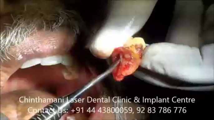 Painless Extraction of Lower Wisdom Tooth with severe periodontal abscess in a Diabetic Patient