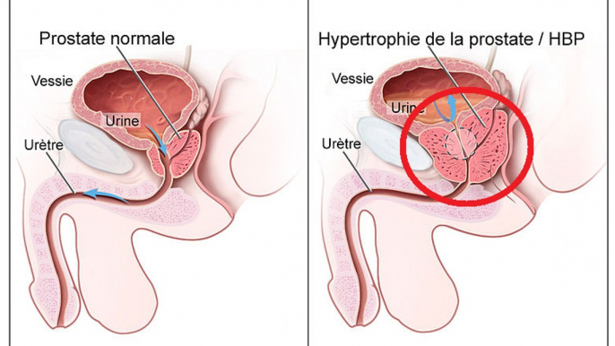 Urologie - Comment prévenir le cancer de la prostate