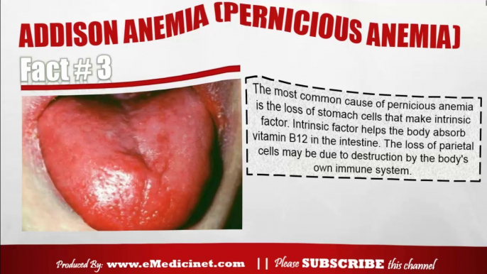 Information about Addison Anemia (Pernicious Anemia)