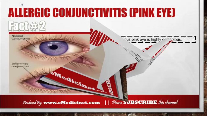 Information about Allergic conjunctivitis (Pink eye)