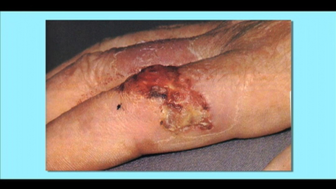 Squamous Cell Carcinoma (Skin Cancer)