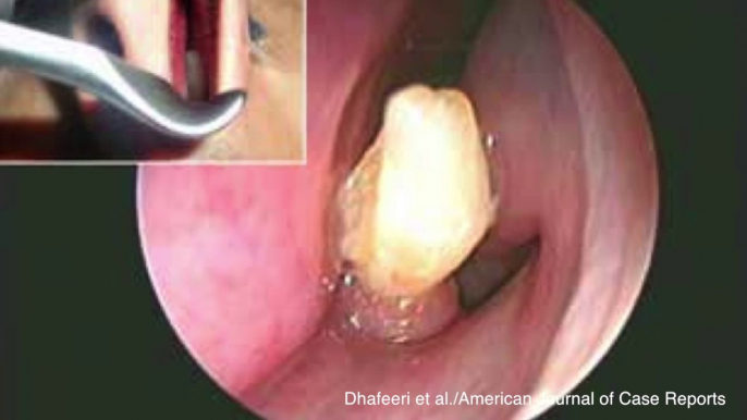 Doctors Remove Tooth Growing In A Man's Nose