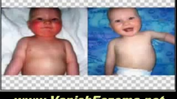 Treatment For Baby Eczema - Beat Eczema Now