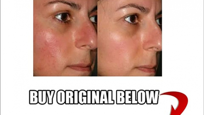 Revitol Rosacea Cream - Buy From Original Vendor Here!