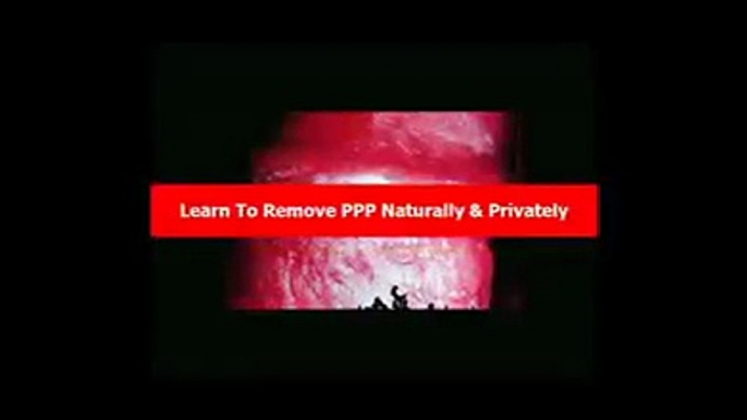 Pearly Penile Papules Removal Houston Pearly Penile Papules Removal Toothpaste