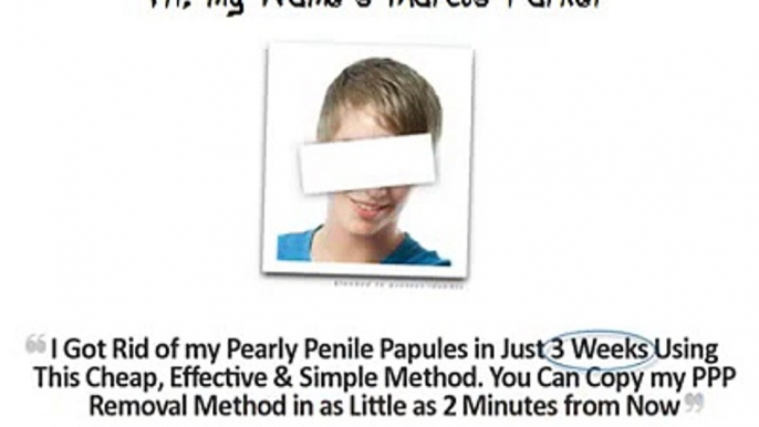 Pearly Penile Papules Removal--Real Pearly Penile Papules Removal