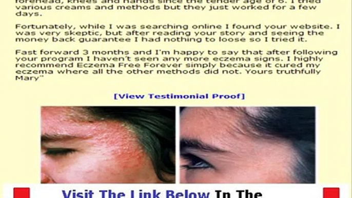 Eczema Free Forever FACTS REVEALED Bonus + Discount