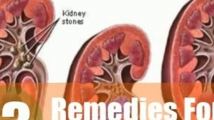 kidney stone relief at home THIS IS THE EASY kidney stone remedy 123