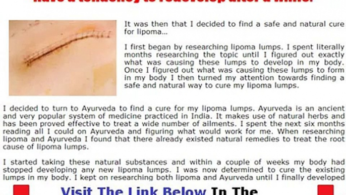 Cure Lipoma WHY YOU MUST WATCH NOW! Bonus + Discount