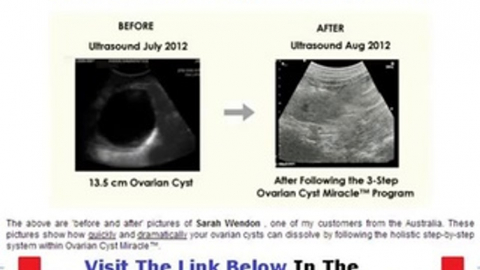 Ovarian Cyst Miracle Don't Buy Unitl You Watch This Bonus + Discount