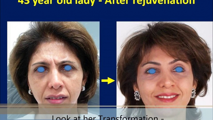 Facelift Surgery, Best Anti-Aging Wrinkle Treatment Rhytidectomy Mumbai India