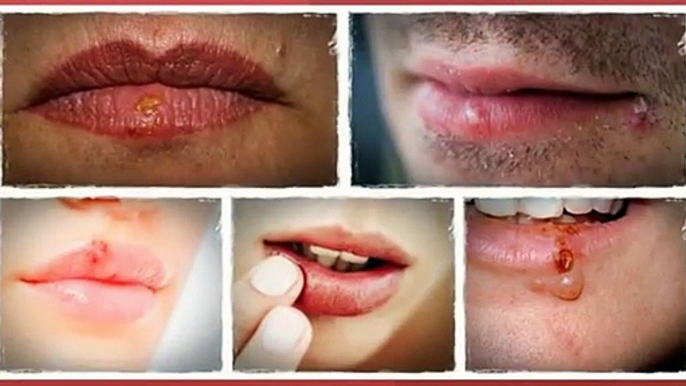 Get Rid Of Cold Sores Fast Review-Home Remedies For Cold Sores