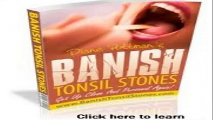 Banish Tonsil Stones Book - Banish Tonsil Stones Book Review