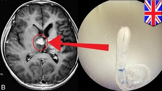 Hombre en el Reino Unido descubrió que tenia una solitaria viviendo en su cerebro