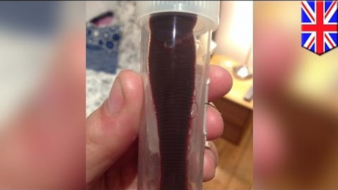 Disgusting! 3-inch-long leech spent month up the nose of British backpacker Daniela Liverani