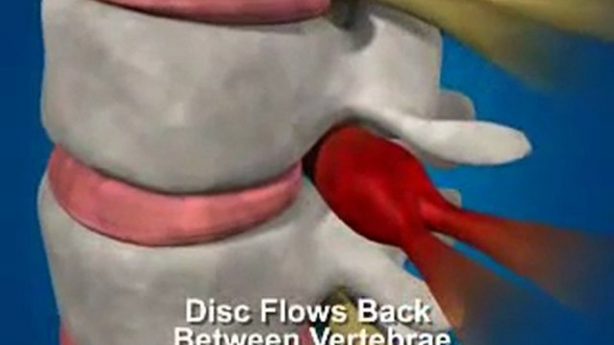 Atlanta Disc Herniation/Bulge Relief - Chiropractor Atlanta