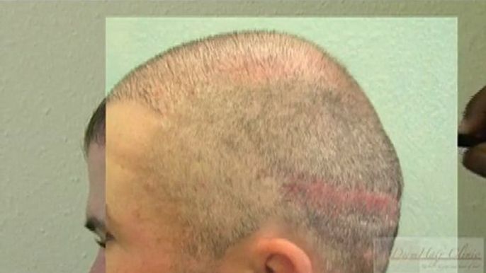 hair restoration, hair transplant, fue