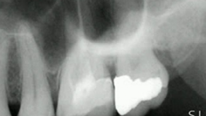 Intraoral Case Studies Imaged with Suni Sensors: Chapter 4