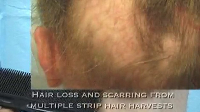 Worst Hair Transplant Result - Repair Using FUE & BHT