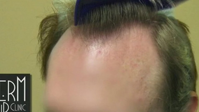 FUE Hair Restoration results - Follicular Unit Extraction