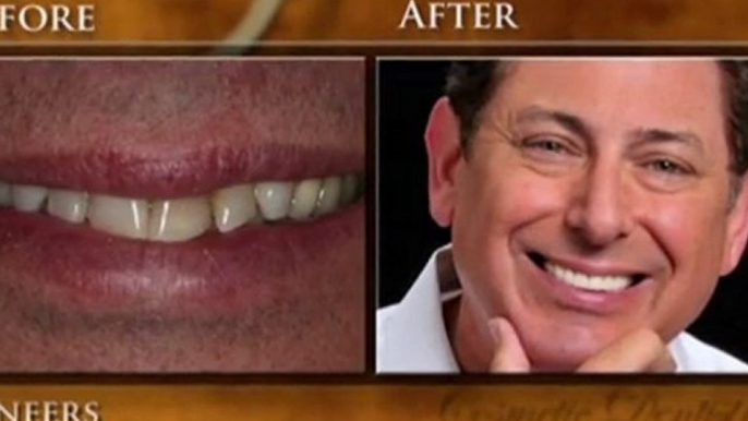 Cosmetic Dentistry Institute - Troy & Detroit–Veneer Patient