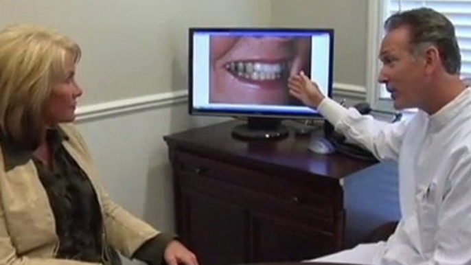 Veneers & Crowns Patient of Dr. Goldin in Clawson & Troy MI