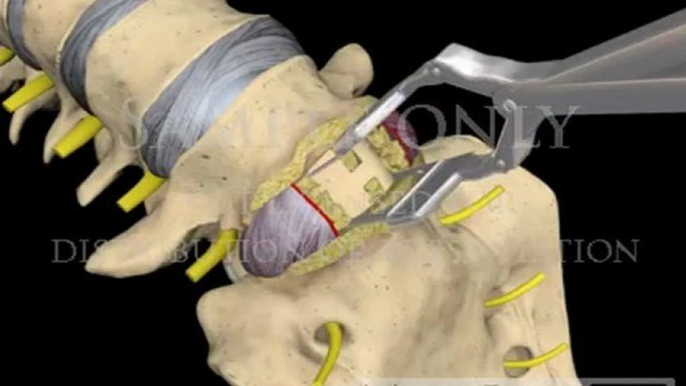 Lumbar Spine Surgery Anterior Interbody Fusion with bone + plate neurosurgical 3D animations