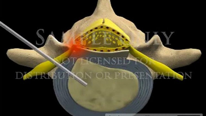 Lumbar Spine Surgery Percutaneous Manual Discectomy surgical 3D animations