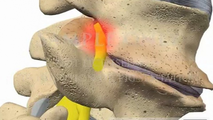 Lumbar Spine Movement Intervertebral Degenerative Disc Disease chiropractor 3D animations