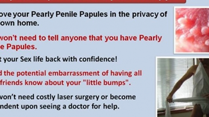 pearly penile papules treatment - penile pearly papules - how to get rid of pearly penile papules