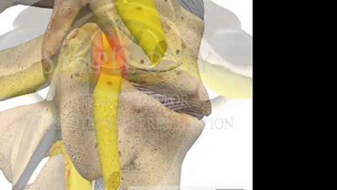 Cervical Spine Pathology Intervertebral Degenerative Disc Osteo-arthritis Disease Bone Spondylosis models 3D spine