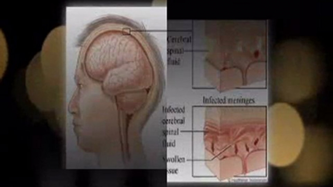 Symptoms of Bacterial Meningitis To Know