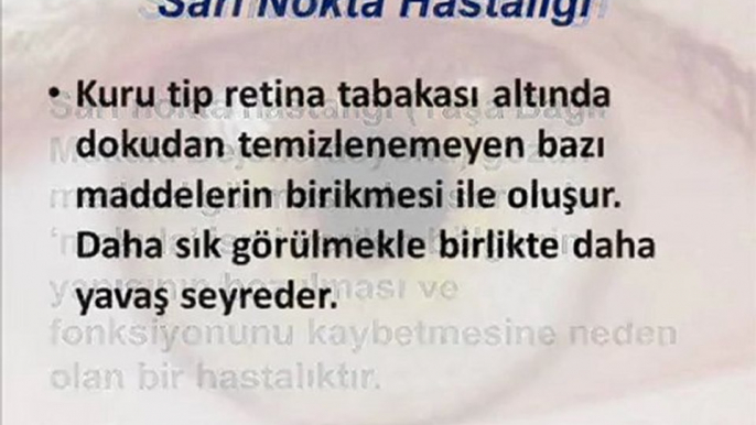 Sarı Nokta,Sarı Nokta Hastalığı,Sarı Nokta Göz Hastalığı,Sarı Nokta Hastalığı Belirtileri