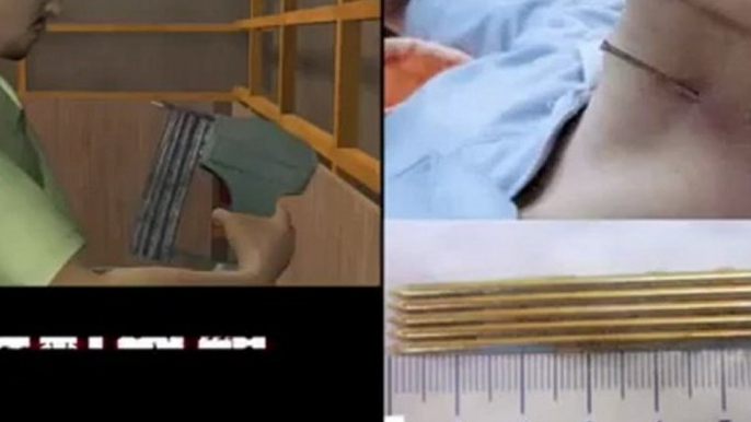 Miracle! Man survives one in a million nail gun neck shot