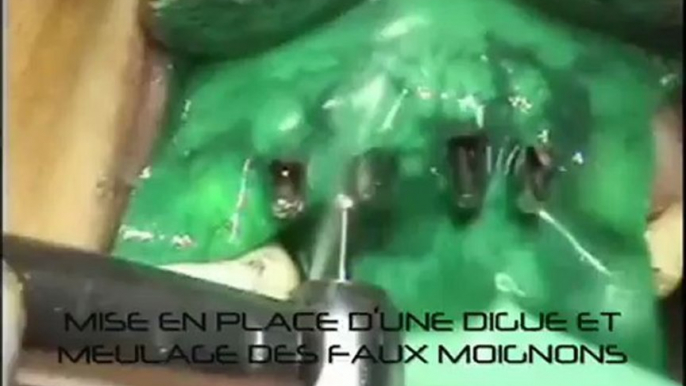 Implants dentaires - Chirurgie : 2eme Temps chirurgical 4 implants - CAS MAI 2011 - Drive Implants