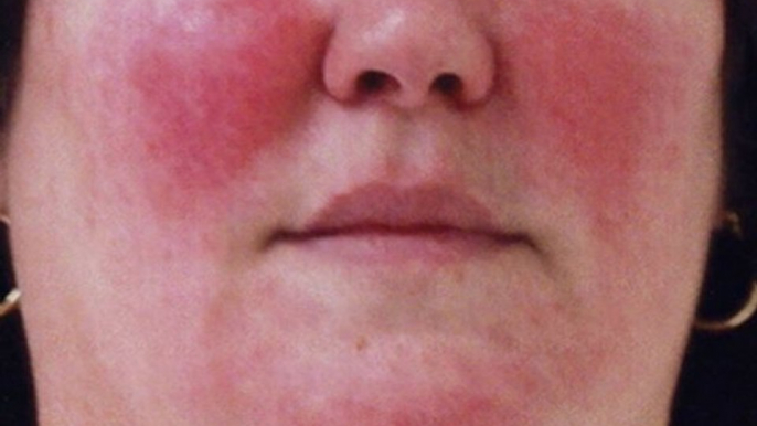 Rosacea Treatment - Skin Care To Reduce Redness