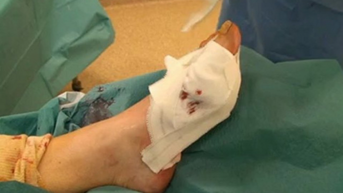 Hallux Valgus, traitement par la chirurgie mini-invasive percutanée