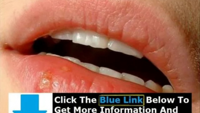 How To Get Rid Of Herpes On Your Lip + Can I Get Rid Of Herpes