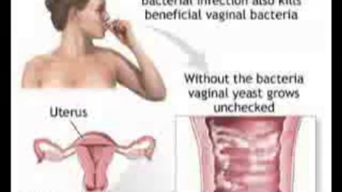 cure male yeast infection Natural Cure for Yeast Infection.mp4.avi cure male yeast infection